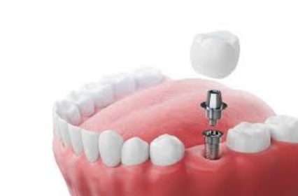 dental implants in Vasant Kunj